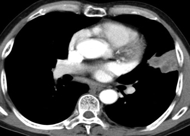 . xial chest T scan shows multiple low attenuation cysts within peripheral