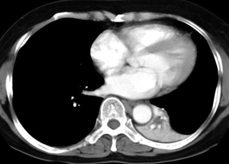 The nodule seems to be located centrally, but shows subpleural location with focal