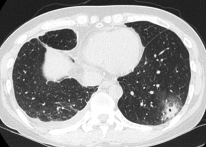 Right pleural effusion is also seen.