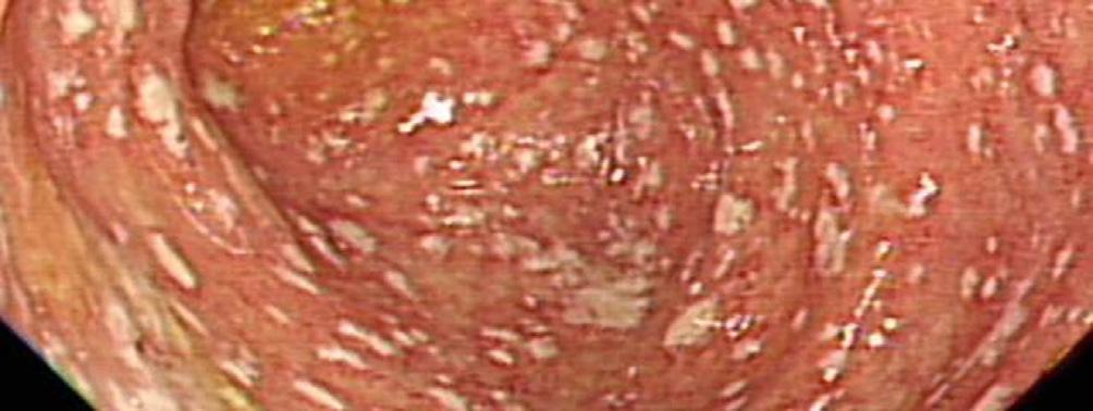 Giardiasis의진단은대변검체를도말하거나십이지장흡인물또는생검조직에서현미경으로포낭또는영양형 (trophozoites) 을관찰하는것으로진단하며, ELISA 또는직접형광-항체측정 (direct fluorescent-antibody assay) 을이용한 Giardia lamblia 항원을검출하는방법등도이용된다 [1,5].