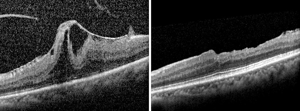 * Idiopathic epiretinal membrane (ERM) without vitreomacular traction syndrome (VMTS); Idiopathic ERM with VMTS; Mann-Whitney test; Wilcoxon signed rank test. A B Figure 3.