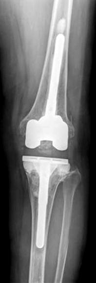 구조적동종골이식은생체적으로적합하고, 숙주골을제거하지않고골결손부위에맞게이식골의모양을맞출후있으며, 인대부착이가능할뿐아니라, 주문형삽입물과비교하였을때가격이저렴하다는장점이있어재치환술또는재재치환술시골결손을해결하는유