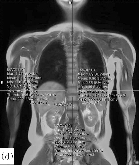 in the PET/CT coronal, sagittal, and transverse