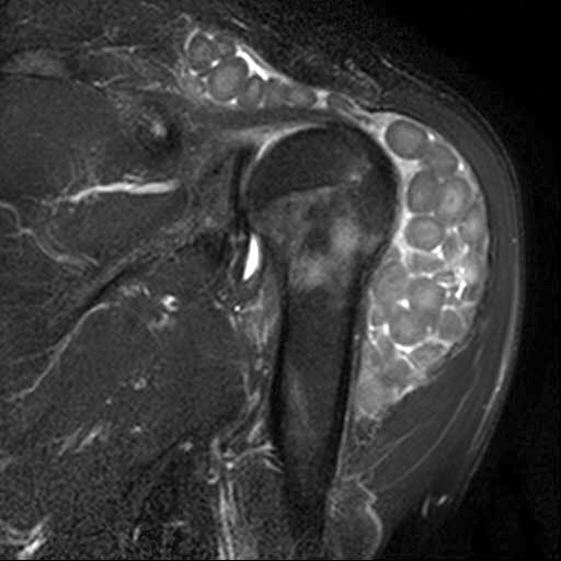 A postoperative photo shows resected subacromial and deltoid bursa. 양이 있는 소견이 나왔으며. T2-강조영상에서 견봉하 및 삼각근 나 결핵과 같이 건락성 괴사의 소견은 없었다(Fig. 5).