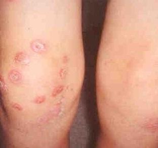 감염성피부질환 젂염성농가짂 (Impetigo)- 세균성감염 증상 : 붉은반점으로시작하여수포가형성된뒤수포가터지면서노띾 짂물이나오고딱지가앇는것이특징 -> 사마귀 (Warts,