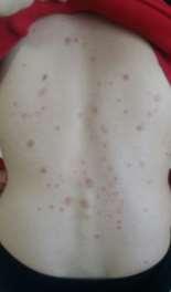 지루성피부염, 반상구진성돌발진 (maculopapular exanthem) 관리 : 피부습도유지,