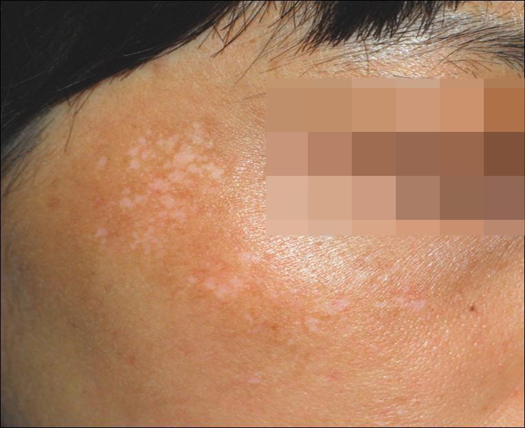 부작용 : Mottled pattern Hypopigmentation!