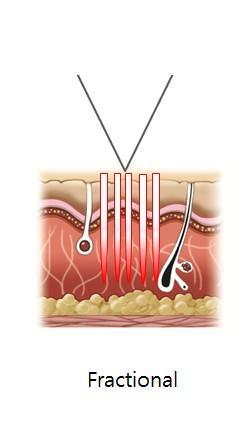 Er:YAG Fractional