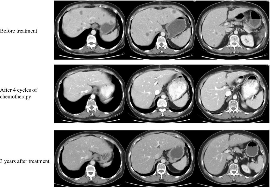 Hyun Young Jung, et al. The significance of PET in non small cell lung cancer Figure 1. A case of metastatic colon cancer treated with FOLFIRI (5FU/FA/Irinotecan) + Cetuximab.