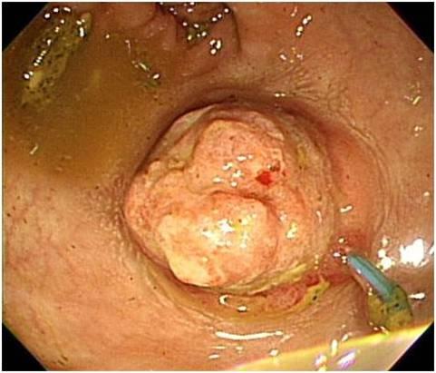 - 대한내과학회지 : 제 83 권제 2 호통권제 624 호 2012 - Figure 4. Two-month follow-up colonoscopic findings. () The lipoma had decreased to 25% of its original size after 2 months.
