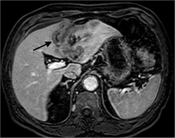 (c) Axial pre-contrast T1-weighted image shows hypointense mass (arrow)