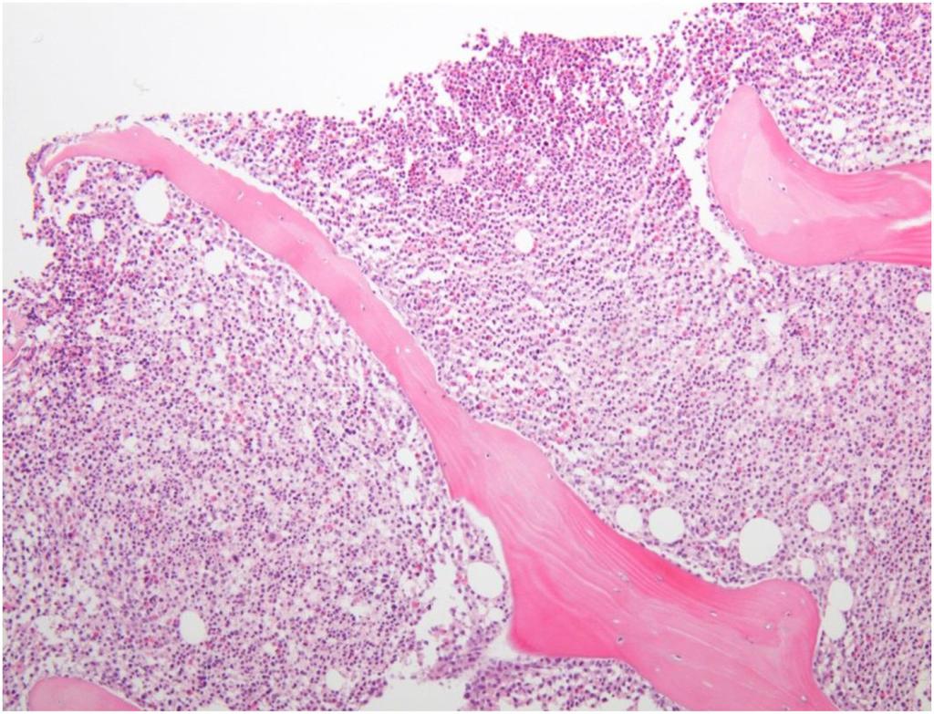 - 대한내과학회지 : 제 91 권제 1 호통권제 671 호 2016 - A B Figure 2. Morphologic and cytogenetic study. (A) Bone marrow biopsy showing increased cellularity and myeloid proliferation ( 100).