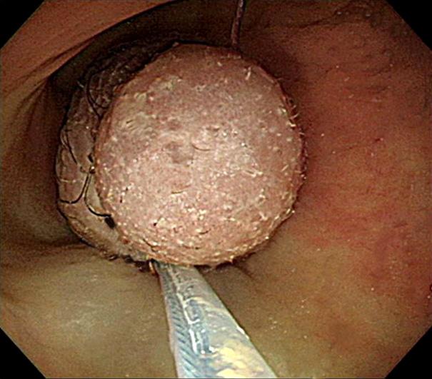 포함한피부와같은양상의점막으로덮여있었는데, 표면에흑색모발이나있었으며이분엽상을보였다 (Fig. 2). 병리조직학적확진을위하여내시경절제술을시행하였다 (Fig. 3).