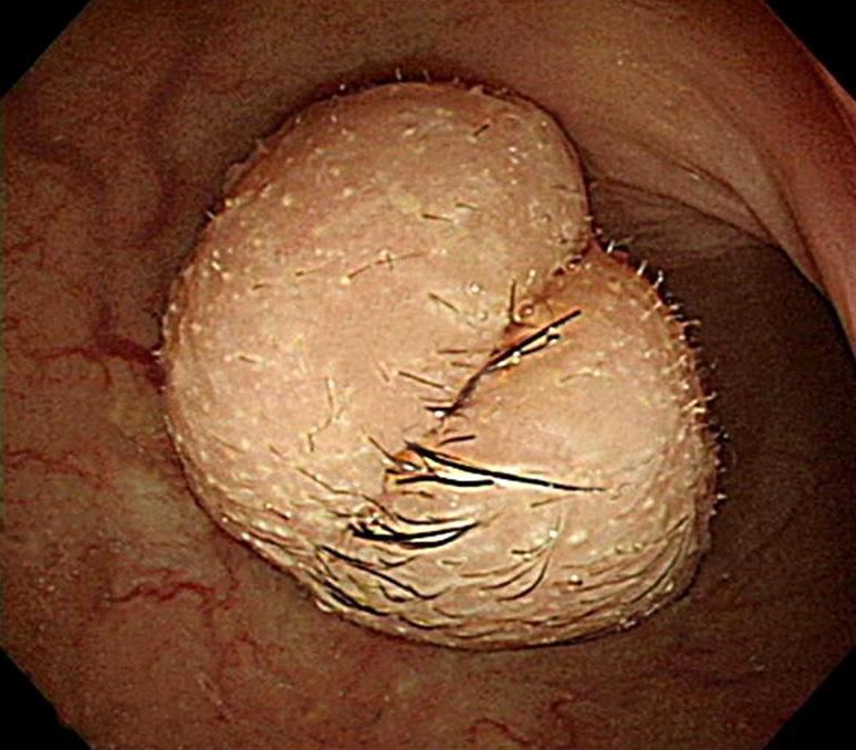 A 21 mm-sized, fat and calcium containing, well-defined polypoid lesion with narrow stalk (5 mm, red-cross) is noted in upper rectum.