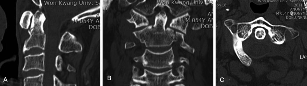 Journal of Korean Society of Spine Surgery Hypoplasia of the Posterior Arch of the Atlas 고찰 제 2경추치돌기골절의경우 Anderson 과 D Alonzo 의제2 형의치료에대해서는아직도논란이있다.
