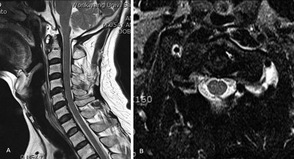 Sung Kyun Oh et al Volume 19 Number 2 June 2012 Fig. 3. Magnetic resonance imaging of the cervical spine.