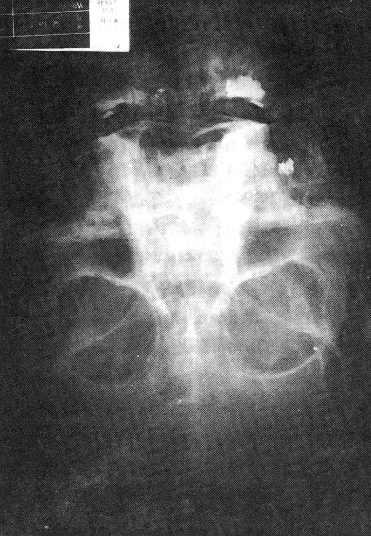 2차수술(97년 5월 20일) 잔여 파편의 정확한 위 치를 알기위해 부비동 전산단층촬영을 시행한 후(Fig. 4) 전신마취하에 비내시경과 C-arm을 이용하여 접 형동주변과 하비갑개, 연구개에 남아있던 납탄 파편을 게거 하였으며 연구개부위의 창상을 봉합하였다.
