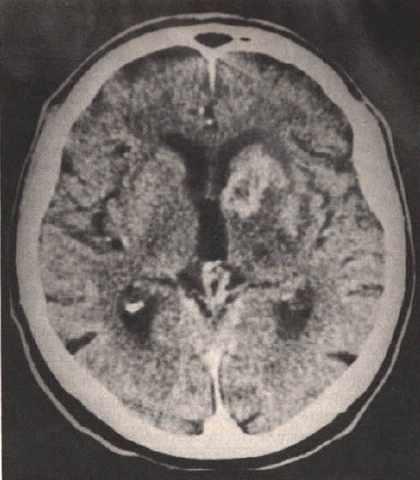 X- 선 computed tomography (CT), computed axial tomography (CAT) 3차원 X-선영상을얻는방법은 Cormack