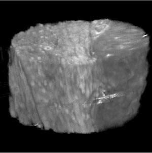 그림 31 phase-contrast X-ray로찍은사람의콩팥샘플 ( 직경 5mm). 영상은물과샘플간의굴절율의차이를써서얻어진다. 어두운영역에암이있다. 그림 32 사람의유방암표본 (specimen).