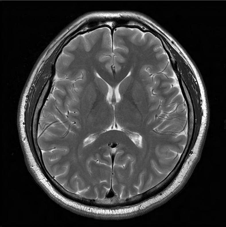 Chapter II CT MRI Basal ganglia Corpus callosum Head of caudate nucleus