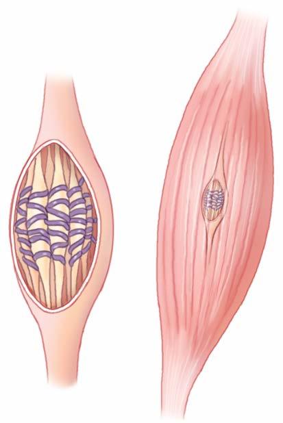 Amelioration of muscle atrophy I.M.