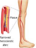 2 nd Target Disease of VM202 Chronic, Non-Healing,