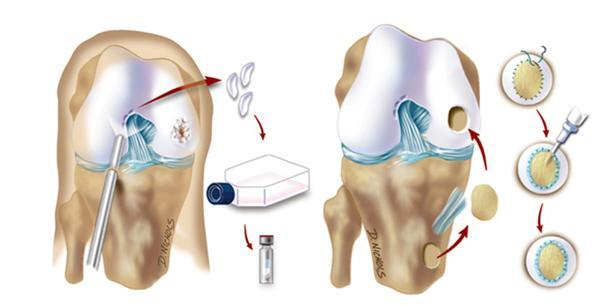 Artificial Skin Biopsy of healthy cartilage