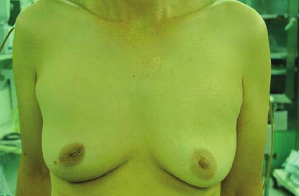 The level of nipple and scar in both sides