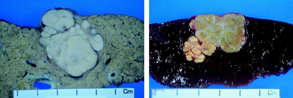 간세포암종, 다결절융합형 (multinodular confluent type) Fig. 7.