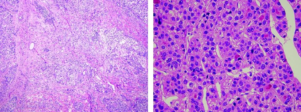 Fig. 7.21. 간세포암종, 투명세포형 (clear cell type).