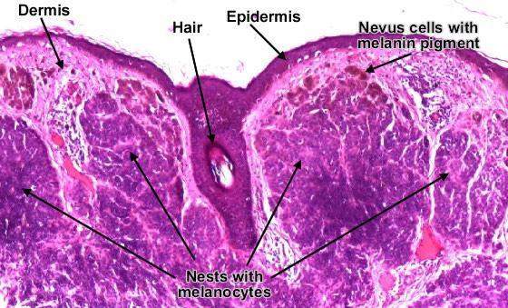 CO2 레이저 Nevi Nevus Tumor made up of nevus cells, derived from melanocytes 모반선천성으로나타나는피부의점. 이른바모반세포 (nevus cell: 멜라닌세포와비슷하지만조금다른, 같은계통의변형세포 ) 에의해나타남. 치료는외과적절제. ( 지재근.