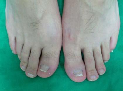 () Improved subungual hyperkeratosis and onycholysis of the toenails after TNF-α inhibitor. Figure 2.
