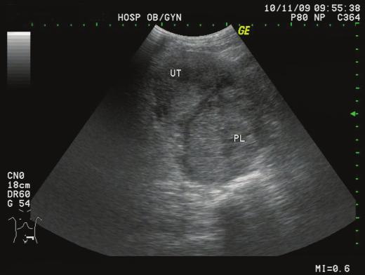 KJOG Vol. 54, No. 6, 2011 A B Fig. 3. (A) Omental band strangulates the fetal neck (thick arrow). (B) Omentum attached to the right fetal shoulder (thin arrow) and anterior chest (white arrow).