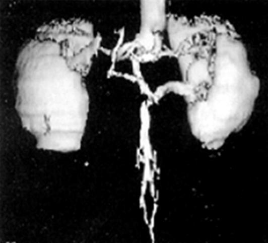 (A) The computed tomography scan of patient 7 shows the retroaortic left