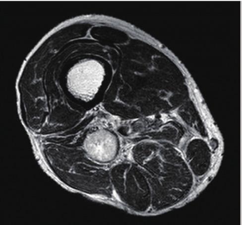 and axial T2-weighted images (arrows) (, ) and multilobulated, peripheral enhancing