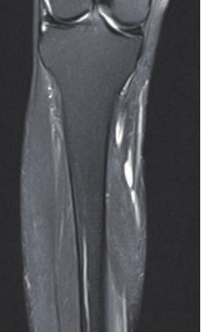 8 cm-sized, well-circumscribed, round mass arising at the right distal sciatic