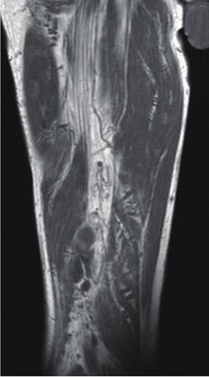 Physical examination revealed generalized pain and a tingling sensation on the right thigh and multiple soft, mobile, non-tender masses at the posterior aspect of the right proximal tibia.