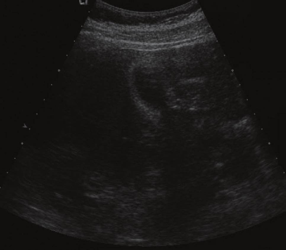 bdominal ultrasonography revealed normal echo texture of the liver, except