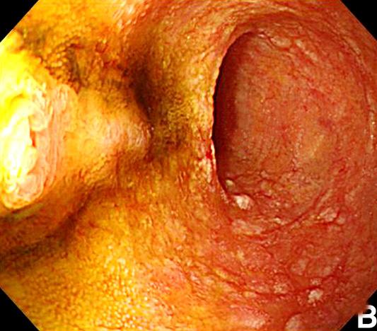 (A) It demonstrates various sized and shaped ulcers in the terminal ileum.