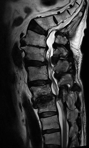 13 Nonsurgical Treatment for Elderly Spinal Patients 은결과를보였지만시상면영상에서디스크의국소적탈출, 단 면영상에서디스크의중앙외측으로의탈출 (paramedian bulging) 을보인경우에는수술로전환된예가많았다고하였다 (Fig. 3). 18) 2.