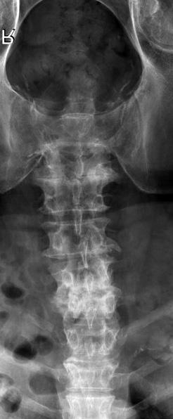 고령환자의 ESI 결과에영향을미치는인자를조사하 였더니환자의나이가얼마나더많은가혹은어떤동반질환이 Sagittal Axial Focal type Median type Hernia Spinal cord Diffuse type Paramedian type Figure 3.