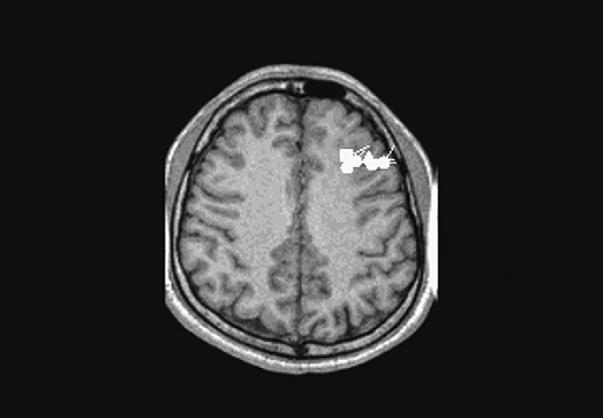 A B C D E F Figure 2. A) A 27 year old male patient presents with chronic epilepsy.