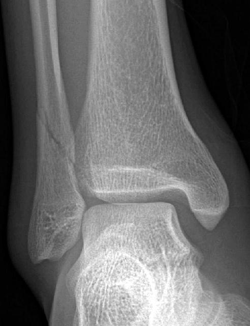 medial clear space and increased tibiofibular clear space.