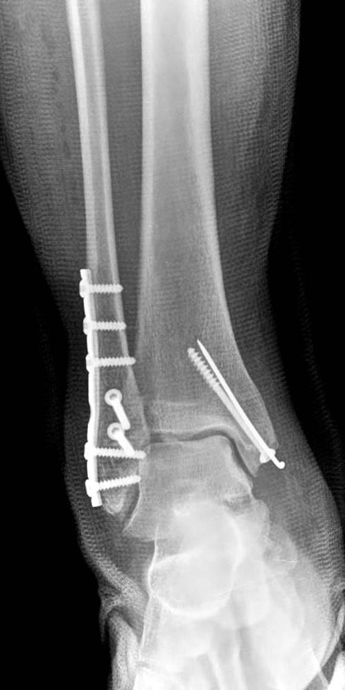 (A) Anteroposterior radiograph shows pronation-abduction stage III ankle fracture.