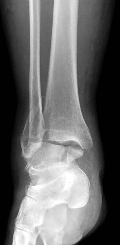 (C) Postoperative anteroposterior radiograph shows accurate anatomical reduction