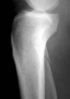 supination-external rotation ankle fracture associated with