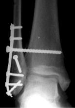Ankle syndesmotic injury. J Am Acad Orthop Surg, 15:330-339, 2007.