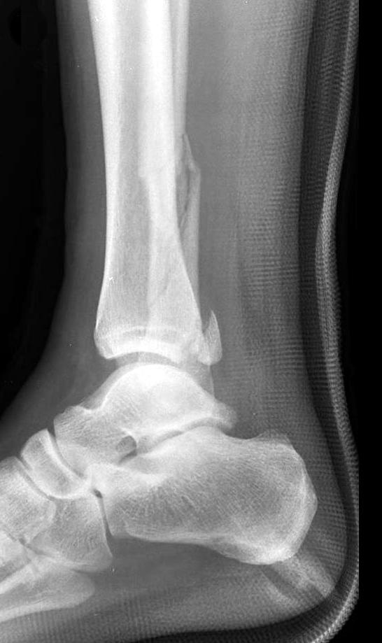 하지만 환자에 따라 여러 상황이 달라질 수 있으므로 경비 인대 결합의 불안정 정도와 비골의 크기에 따라 고정하는 피질골의 수와 나사못의 크기를 결정하는 것 이 필요하다 (Fig. 8-10). Fig. 10. A 48-year-old man slipped and sustained a fracture of the ankle.