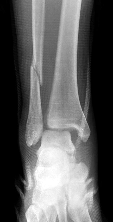 (B) Lateral radiograph demonstrates posterior malleolar fracture.