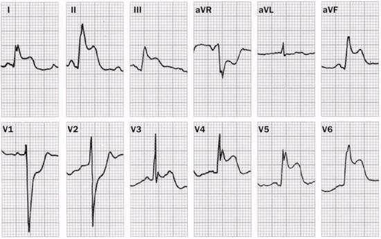 3) Waveform Description 주의깊게 P-waves, QRS complexes, ST segments, T waves, U wave 를분석하여다음과같은소견을파악하여야한다. P waves : are they too wide, too tall, look funny (i.e., are they ectopic), etc.